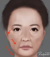 真童妍拉提術｜複合式治療成為醫美未來趨勢！