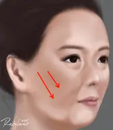 真童妍拉提術｜複合式治療成為醫美未來趨勢！
