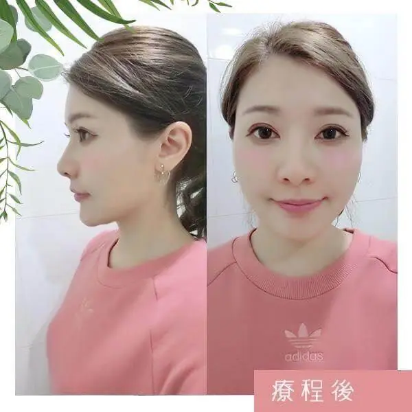 玻尿酸注射