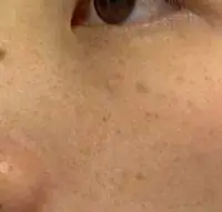 雀斑