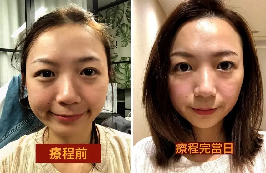 凱西 : 除了瑜珈運動之外的醫美保養之路－第一次嘗試音波拉提＋玻尿酸填補