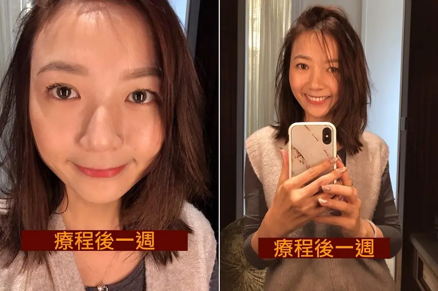 凱西 : 除了瑜珈運動之外的醫美保養之路－第一次嘗試音波拉提＋玻尿酸填補