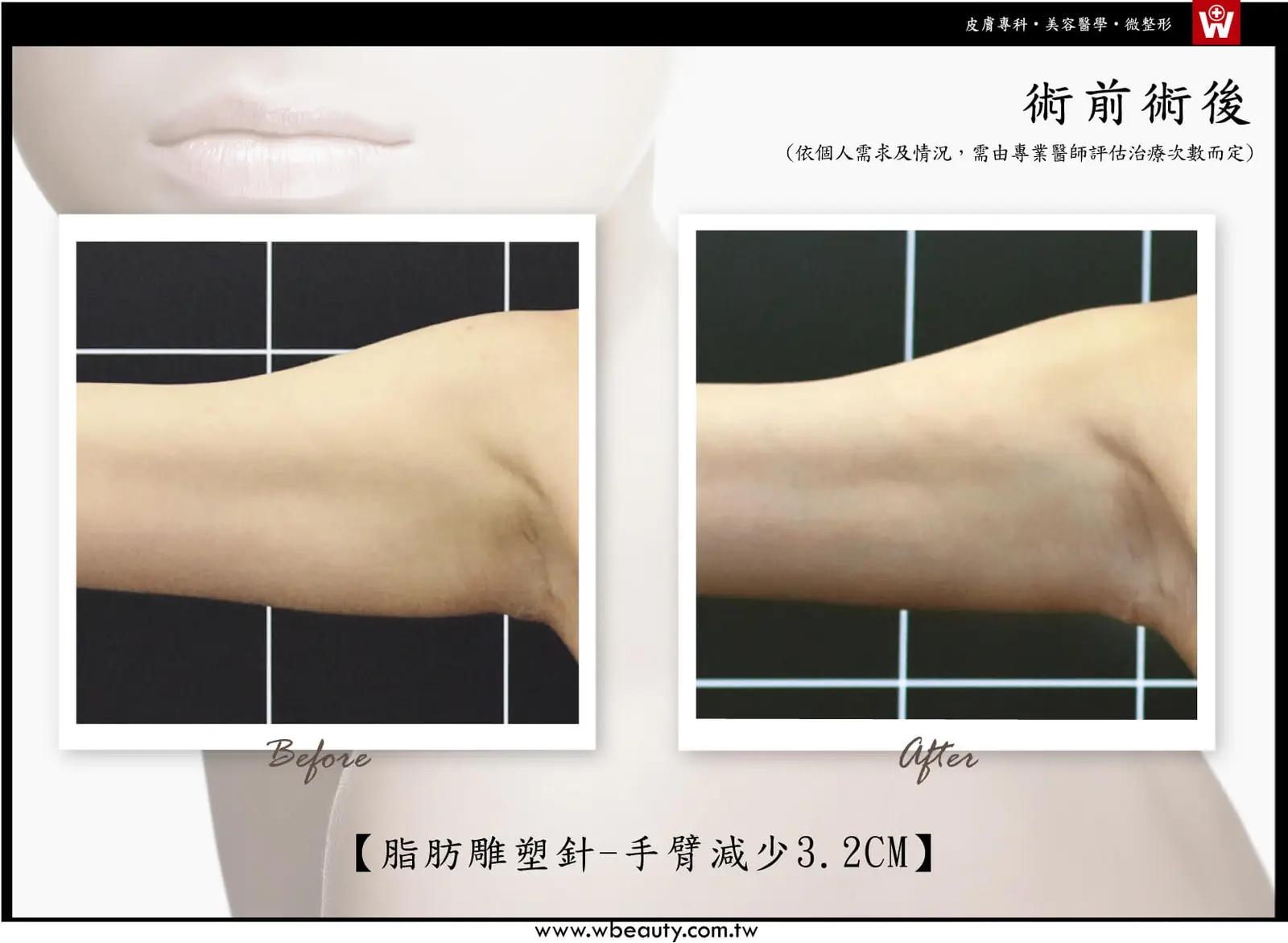 脂肪雕塑針-手臂術後減少3.2CM