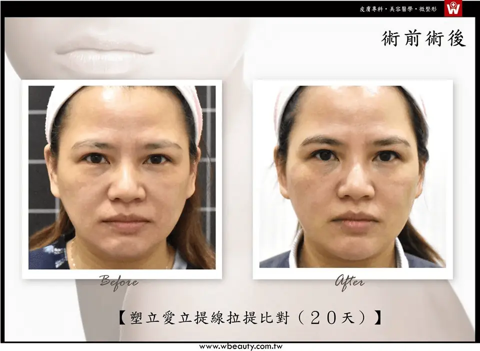 拉提界的新星—少女線