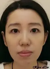 小資女的肉毒V臉術