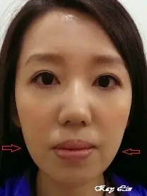 小資女的肉毒V臉術