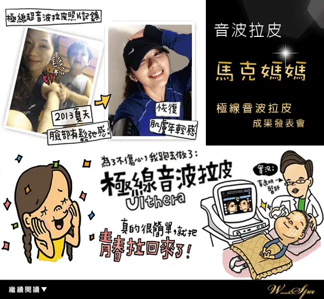 Ulthera極線音波拉提