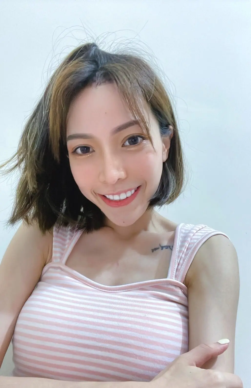 玻尿酸注射