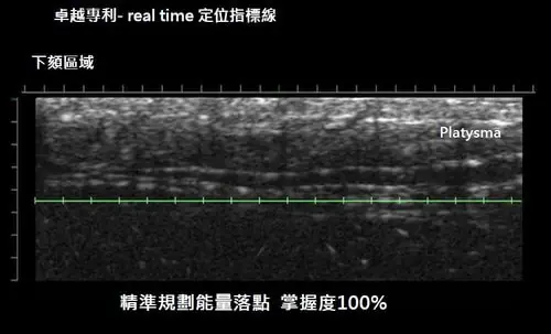 Ulthera4